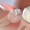 Can I Have My Wisdom Teeth Removed While Under the Effects of Sedation Dentistry?