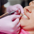 The Comfortable Path To A Perfect Smile: Sedation Dentistry For Porcelain Veneers In Taylor, Texas
