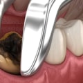 How Long Does It Take to Recover from Sedated Tooth Extraction?