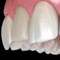 Maximize Comfort And Minimize Anxiety: Porcelain Veneers In McGregor, Texas, With Sedation Dentistry