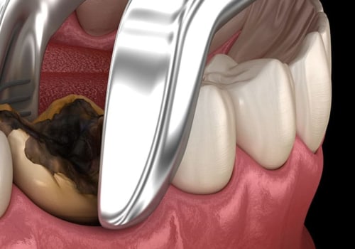 How Long Does It Take to Recover from Sedated Tooth Extraction?