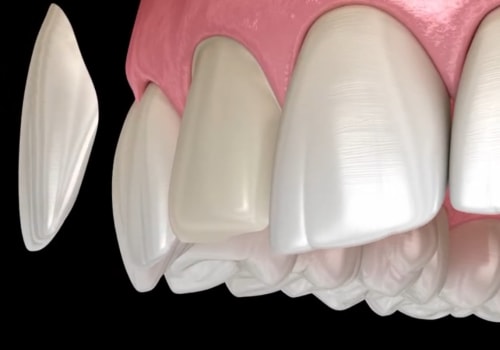 Maximize Comfort And Minimize Anxiety: Porcelain Veneers In McGregor, Texas, With Sedation Dentistry